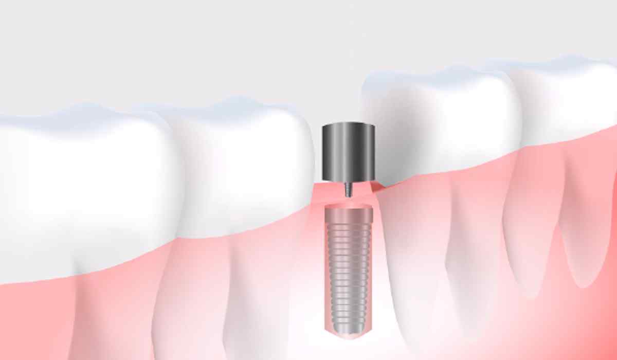 https://dentalestetik.al/wp-content/uploads/2023/05/tab_image_01.jpg