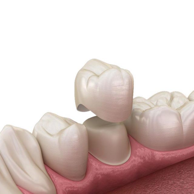Dental-Crowns-in-Turkey-640x640 https://dentalestetik.al/wp-content/uploads/2024/04/Dental-Crowns-in-Turkey-640x640-1.jpg