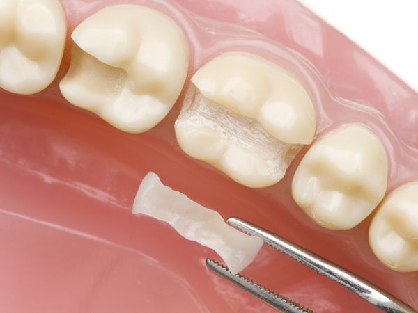 dentalpraxis-schwaz-fuellungen-small https://dentalestetik.al/wp-content/uploads/2024/04/dentalpraxis-schwaz-fuellungen-small.jpg
