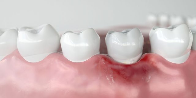 teeth-model-with-gum-disease-1-640x320 https://dentalestetik.al/wp-content/uploads/2024/04/teeth-model-with-gum-disease-1-640x320-1.jpg